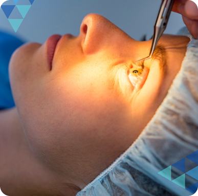 LASIK, PKR ou SMILE : quelle technique pour vos yeux ?
