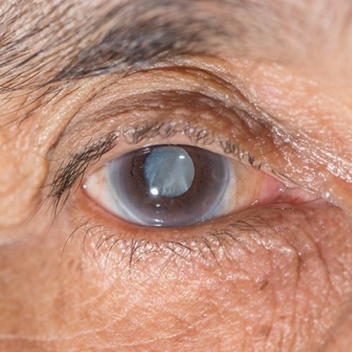 Voici un texte alternatif optimisé pour le SEO et l'accessibilité de cette image illustrant la cataracte : Gros plan sur un œil atteint de cataracte, présentant l'opacification du cristallin prise en charge au cabinet du Dr Gherieb